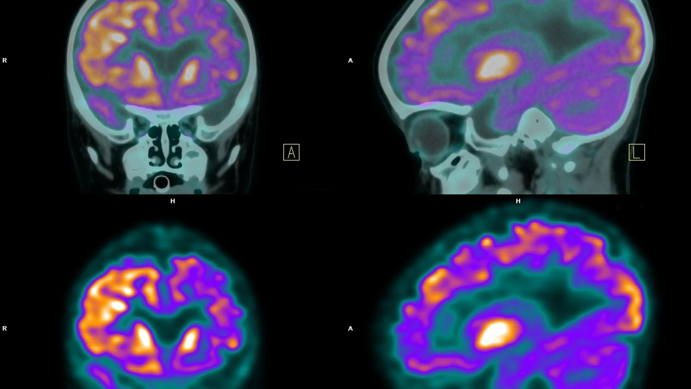 Пэт с тирозином. Позитронно-эмиссионная томография мозга. Позитрон-эмиссионная  томография: ПЭТ. Позитронно-эмиссионная томография снимки мозга. Позитронно-эмиссионная томография (ПЭТ) снимки.